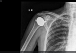 X Rays of new right shoulder joint